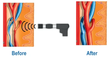 Improved Metabolism & Microcirculation Improved Metabolism & Microcirculation