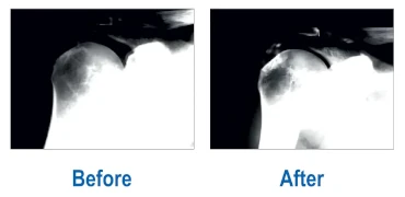 Dissolution of Calcified Fibroblasts Dissolution of Calcified Fibroblasts